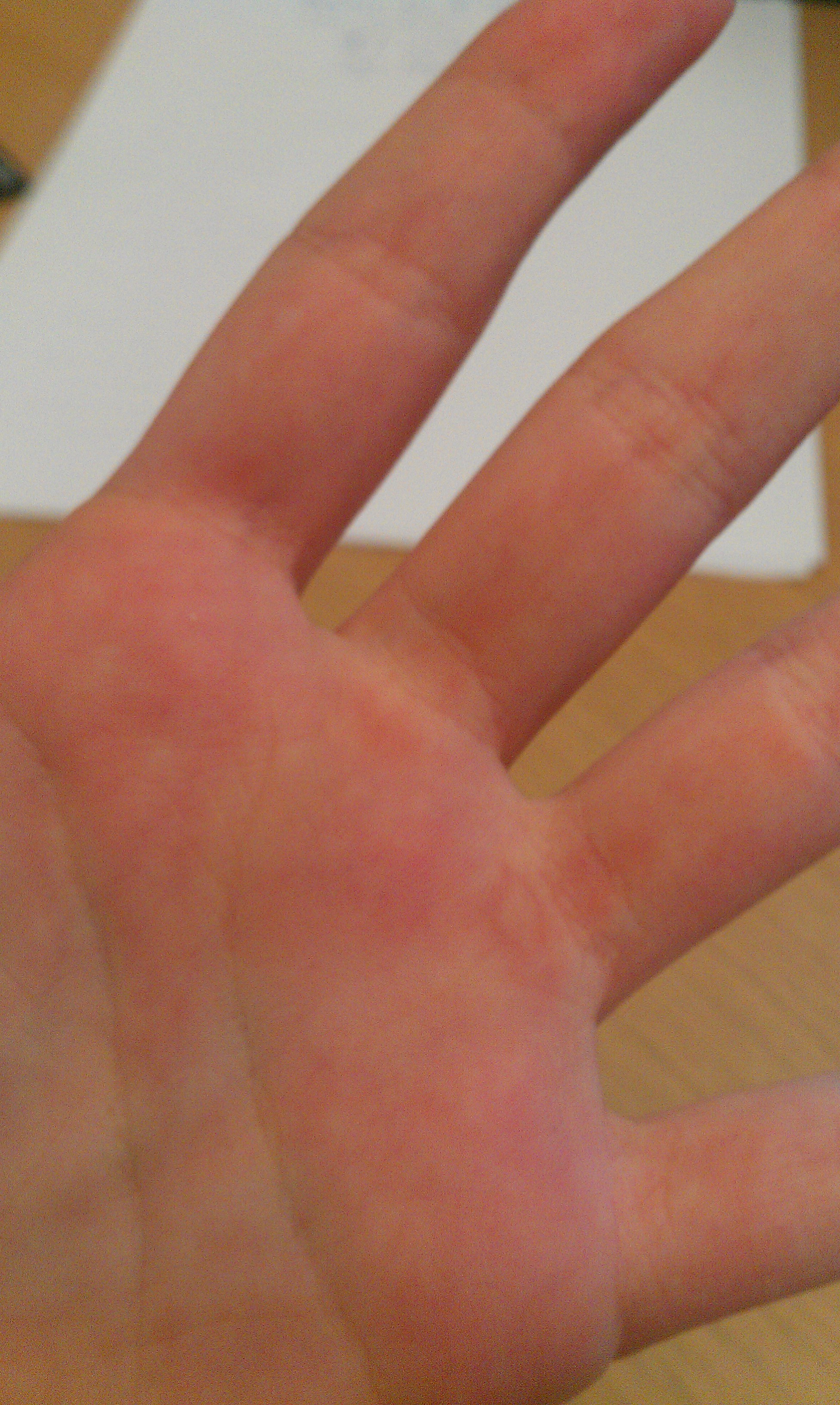 blisters-on-hands-from-weightlifting-clipart